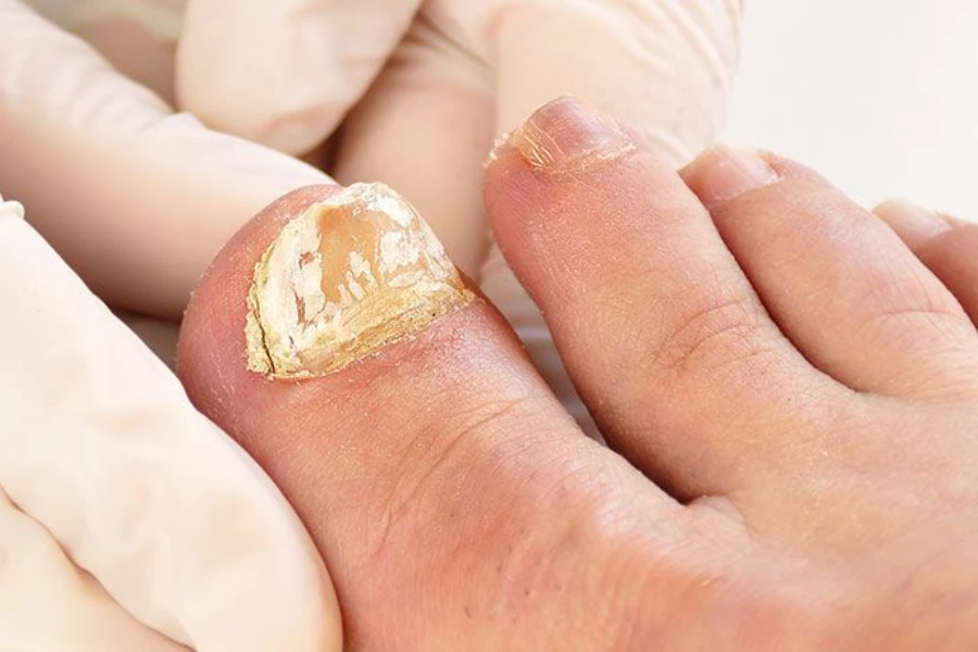 Fungal nail treatment in progress at SkinKouture